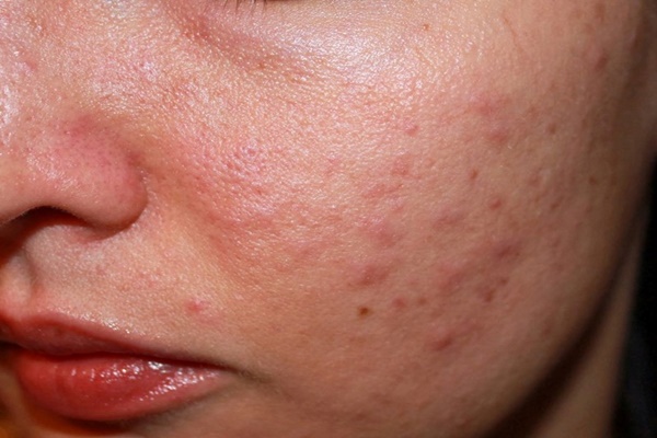 Da mặt khô rất nhạy cảm và dễ nổi mụn. 