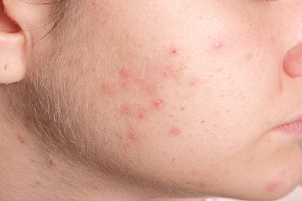 Mụn bọc không đầu thường mọc riêng lẻ hoặc xuất hiện thành từng vùng trên da.