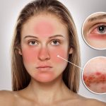 Da nhạy cảm là gì? Dấu hiệu nhận biết và cách phục hồi làn da