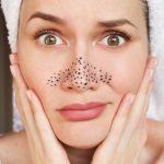 Mụn ẩn là gì? Cách trị mụn ẩn tại nhà vừa an toàn vừa hiệu quả